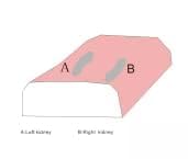 Ultraschall Punktionstrainingsmodell, Doppelniere Biopsie, Doppelniere Zyste Perkutane Punktion Nieren, Multiple Nierenläsion Gewebe