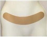 Oleeva 37CS C Section Scar Shape.