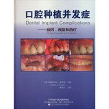 Dental Implant Complications: Etiology. Prevention and Treatment ...