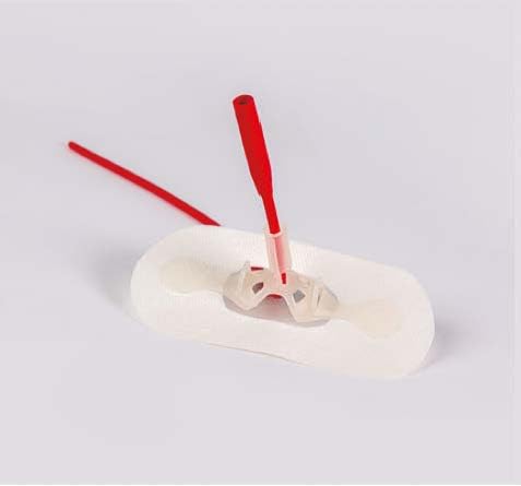 Catheter Stabilization Device (LECS I) Suprapubic Catheter Stabilizer with 100% Hypoallergenic Adhesive for Long-Term Wear by Levity Products (Pack of 5)