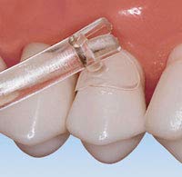 PRM Cure-Thru Cervical Matrice Molar Bx/150