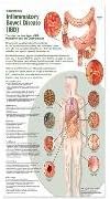 Inflammatory Bowel Syndrome Chart IBD