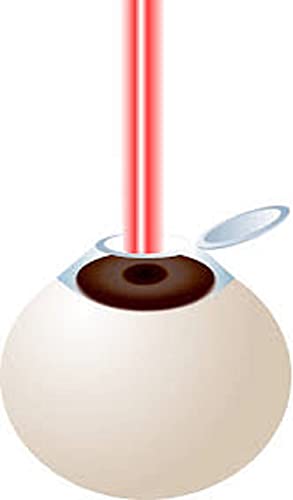 सफल LASIK सर्जरी #: ऑर्थोप्टिस्ट अनुभव (Hindi Edition)