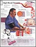 High Blood Pressure chart: Laminated Wall Chart      1st Edition
