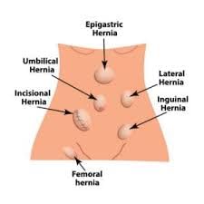 Cinta abdominal para hernia umbilical talla mediana miniatura 6