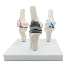 KKI Flexible 3 Stage Arthritis Knee Model with Implant | Perfect Educational Training Tool for Medical Professionals (B0D3B29RCJ) Amazon Price History, Amazon Price Tracker
