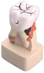 Diseased Tooth Model | Enlarged Dental Model Showing Tooth Decay, Pulp, Cavity & Gum Disease | For Dental Education & Training