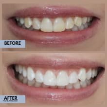 Image of IntelliWHiTE ProStrips Teeth Whitening Strips, 28 Day Treatment, Whitens Up to 12 Shades, Enamel-Safe Gentle Remineralizing Formula, Dentist Formulated for Sensitive Teeth, (56pk Peach Flavor)