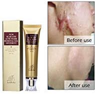 Amareu Acne Scar Removal Cream Skin Repair Face Cream For Burns Cuts Operation Stretch Mark Remover Acne Scars Treatment