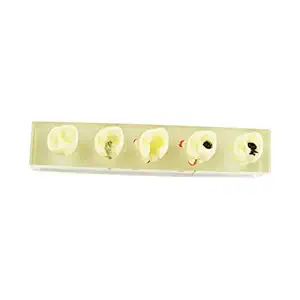 iDENTical Root Canal Model explaining dental caries & periapical pathologies M4012