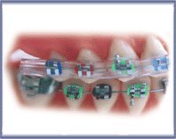 Morgan Bumper Braces Saver - Non Returnable In CLEAR