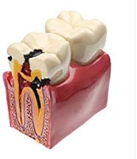 Dental Caries Tooth Model, YOUYA DENTAL Decay Teeth Comparative Study Model 6 Times Caries Tooth Teaching Tools