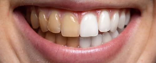 Teeth Whitening Dentist Tips for Long-Lasting Results