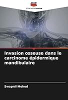 Invasion osseuse dans le carcinome épidermique mandibulaire 6205286807 Book Cover