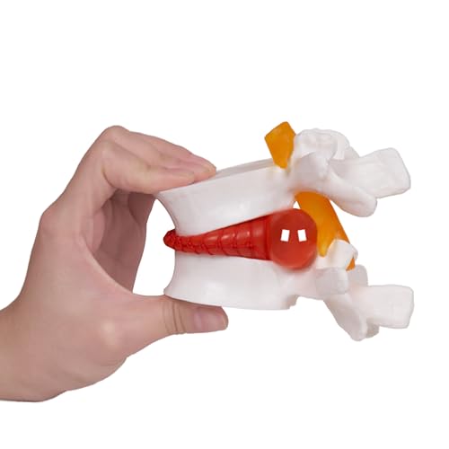 NLShan Human Anatomical Lumbar Disc Herniation Model, Portable He...
