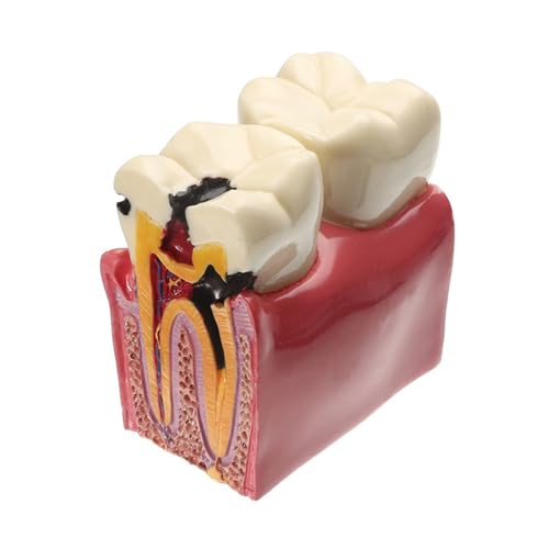 1 Unidad, Aumento de 6 Veces de Caries Dental, Modelo Oral, Herramientas de enseñanza médica