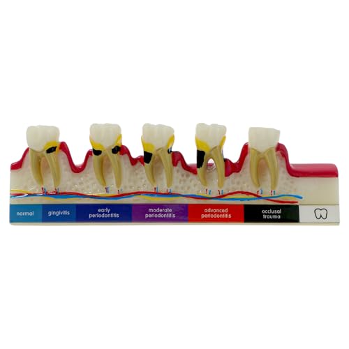 Dental Teeth Model 6-Stage Periodontal Disease Demonstration Model for Dental Education
