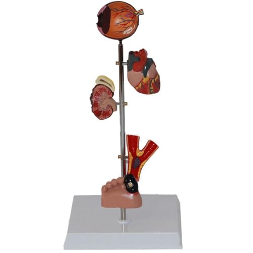 Human Organ Dissection Model Diabetes Pathology Demonstration Anatomy Model Pathological Model Human Diabetic Organ Model Diabetes Complications Display Model Pathological Diabetes Anatomy Model