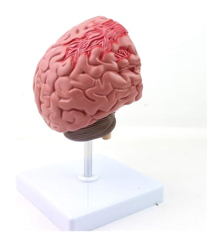 Modelo anatómico de hemorragia cerebral del tronco encefálico y patologías formativas 5