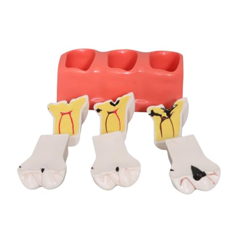 Garende Teaching Model Decay Tooth Classroom Teaching Caries Tooth Model Display Educational Tool for Biology Classroom