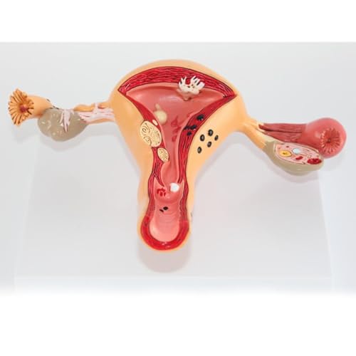 Modèle pathologique utérus ovarien pédagogique pour cours - 4