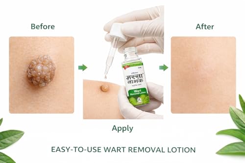 Massa Nashak | Wart removal lotion | Ayurvedic wart removal lotion| No Side effects | Fast Acting.