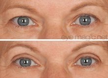 Eye Magic Original Eye Lift Kit (Small/Medium)
