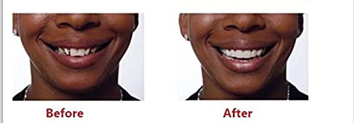 Chnlml Upper And Lower Veneer, Dentures For Women And Men, Fake Teeth, Natural Shade! Top And Bottom Veneers For Cosmetic Teeth, Protect Your Teeth #TOP4