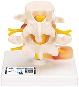 3B Scientific A76 Lumbar Spinal Column w/ Prolapsed Intervertebral Disc - 3B Smart Anatomy