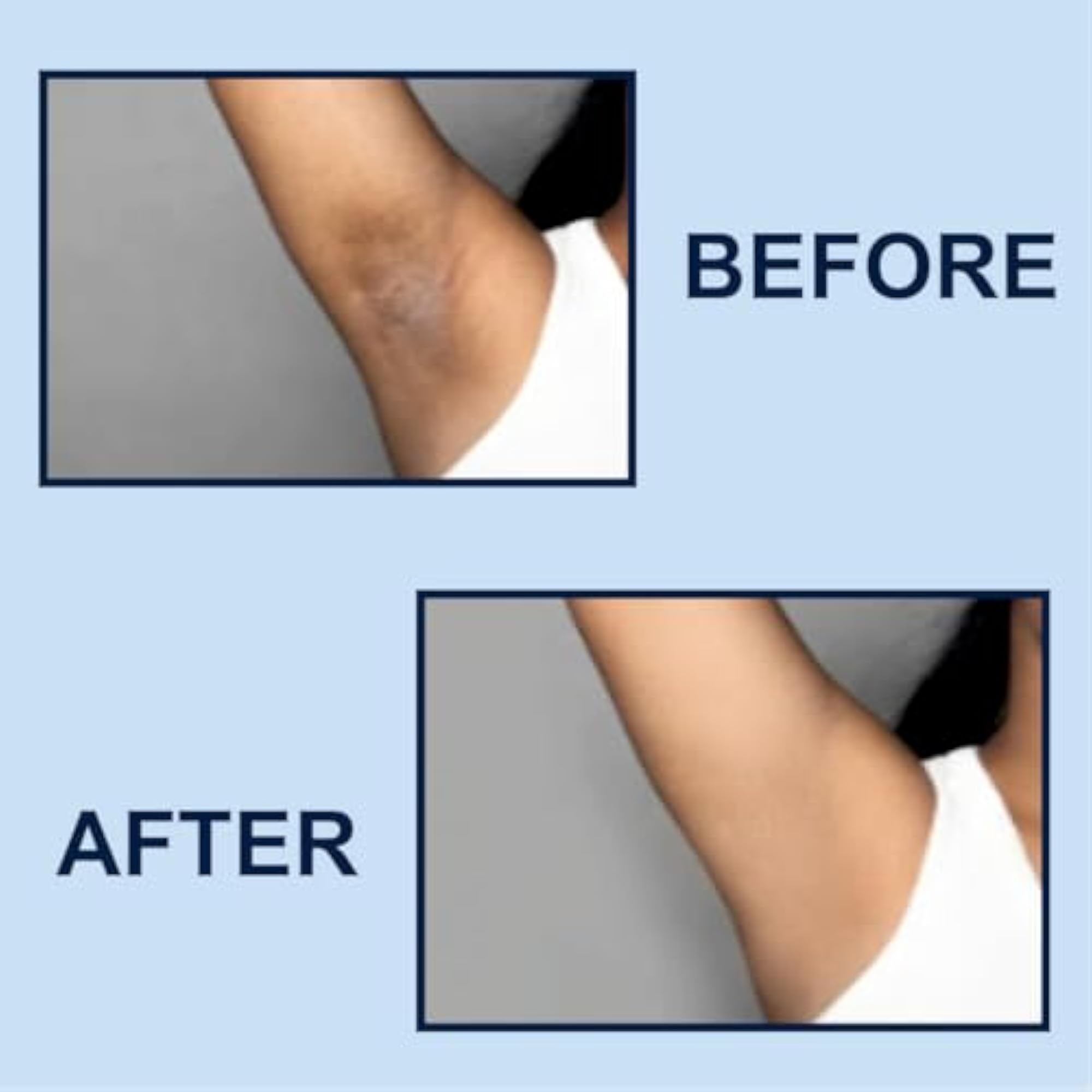 Underarm Roll-On with AHA, Kojic Acid & Hyaluronic Acid