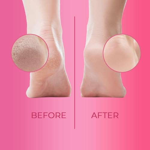 Callus Remover Extra Strength Gel. Removes Tough Callus Instantly. Foot care Strong Formula For Spa Like Pedicures At Home - 30Ml