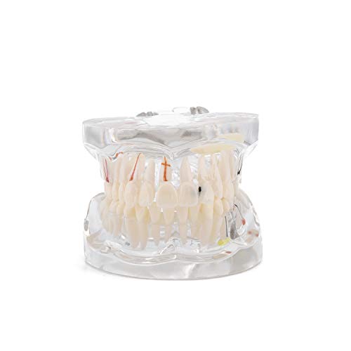 Dental Transparent Disease Teeth Model with Pathological Removable Tooth, Teaching Models Tools