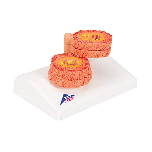 Image of 3B Scientific G50 /1 COPD Model - 3B Smart Anatomy
