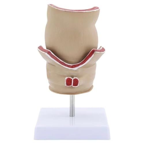Pathologies humaines du modèle de rectum pour enseignement et anatomie médicale