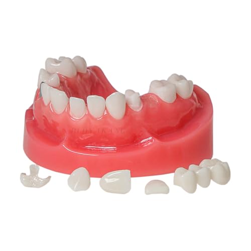 Dental Implant, Dental Bridges Restoration Model Dental Typodont Teach Study Education Dentist to Communicate with Patients Model (M6024)