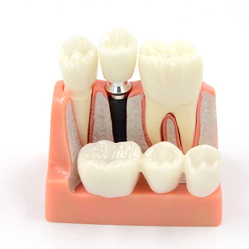 Modèle d'implant 4 fois avec structures anatomiques pour enseignement