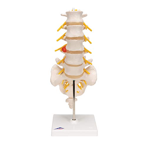 Image of 3B Scientific A76 /5 Lumbar Spinal Column with Dorso-Lateral Prolapsed Intervertebral Disc, 13.4 inch Height