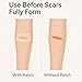 Clear Scar Sheets – 10 Pieces – Skin Patches for Face and Body – Use Before Scars Fully Form – Prevent and Reduce Scars from Acne, Scalds, Burns, Cuts, Abrasions – Thin, Flexible, Waterproof, Gentle