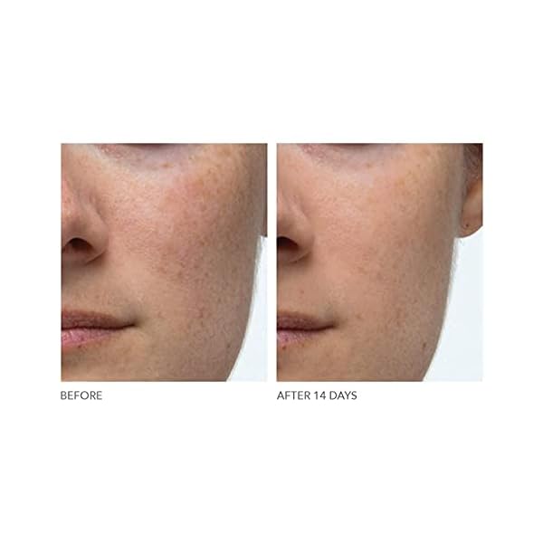 Dr-Dennis-Gross-Alpha-Beta-Extra-Strength-Daily-Peel-for-Oily-Skin-Uneven-Tone-or-Texture-Wrinkles-or-Enlarged-Pores-5-Treatments Dr Dennis Gross Alpha Beta Extra Strength Daily Peel | 2 Step Daily Treatment to Boost Radiance, Refine Pores, Clear Breakouts, and Smooth Lines & Wrinkles | 5 Treatments
