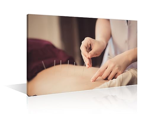 Image of TUMOVO 1 Panels Acupuncture and Moxibustion Large Wall Art Traditional Chinese Medicine Wall Art for Living Room Traditional Art Prints Giclee Print Stretched and Framed Ready to Hang (24 inch Wx36 H)