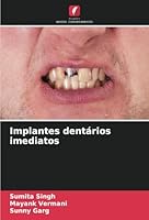 Implantes dentários imediatos (Portuguese Edition) 6208765145 Book Cover