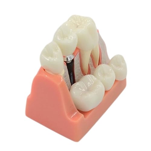 Teach Implant Analysis Bridge Removable Demonstration Teeth Model for Doctor-Patient Communication Models for Patient Education Students Teaching Research