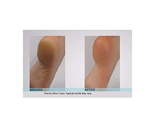 Emjoi Micro-Pedi Callus Remover w/Bonus Replacement Rollers (Turquoise)