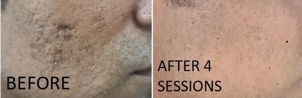 TCAPlatinumDerm 95% Peel (0.3oz/10ml) medium depth chemical peel ideal for Dilutions and spot application on scars with CROSS Technique, for Aestheticians and DIY skincare enthusiasts - Image 5