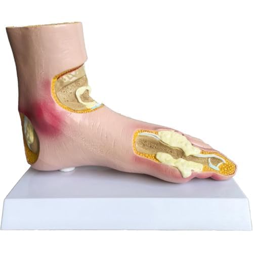 Modelo de pie de gota de tamaño real con tophi articular para enseñanza médica, anatomía patología, pie con soporte, herramienta de aprendizaje de juanetes y podología, simulación de tablero de uñas