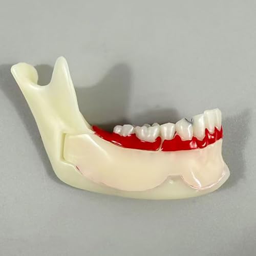 Modèle de dent mandibulaire pour visualiser l'évolution des caries et kystes
