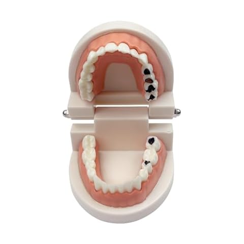 Decay Tooth Model, YOUYA Dental Caries Standard Teeth Teaching Model Study Tool Adult Disease Standard Typodont Demonstration Teeth Model for Kids Oral Care Teaching Cover