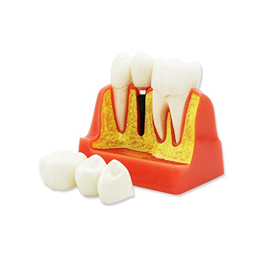 D-IP Dental Teeth Model,Transparent Dental Implant Teeth Model Dentist Standard Disease Removable Tooth Pathological Teaching Model