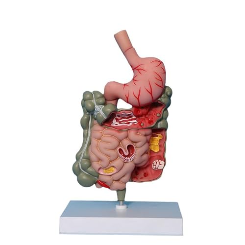 SORECI Human Stomach Anatomy Model Pathological Digestive System Model, Removerable Teaching Model,Stomach Section Large Small Intestine Medical Model Anatomy