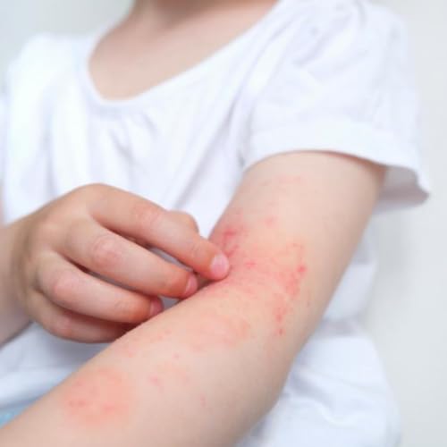 Alergia de c&atilde;es e gatos